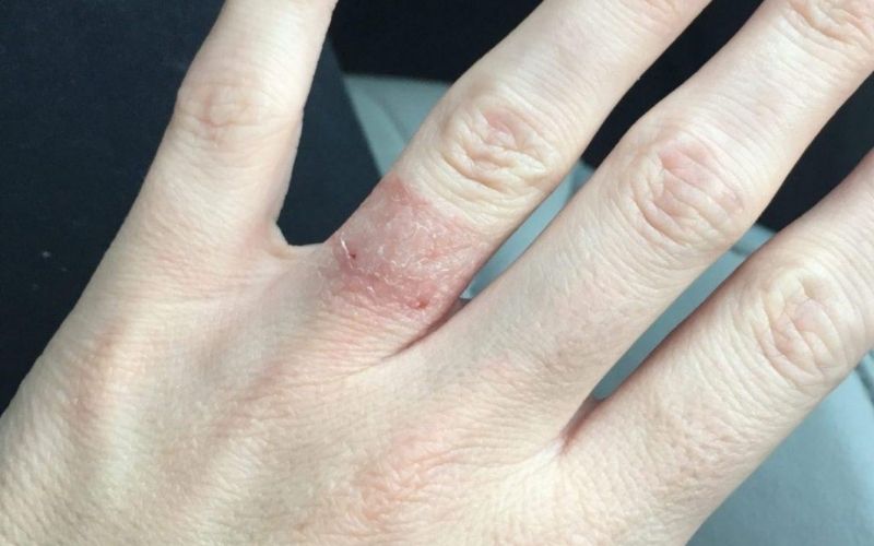 Da của chúng ta có thể phản ứng với một số kim loại, đặc biệt là niken