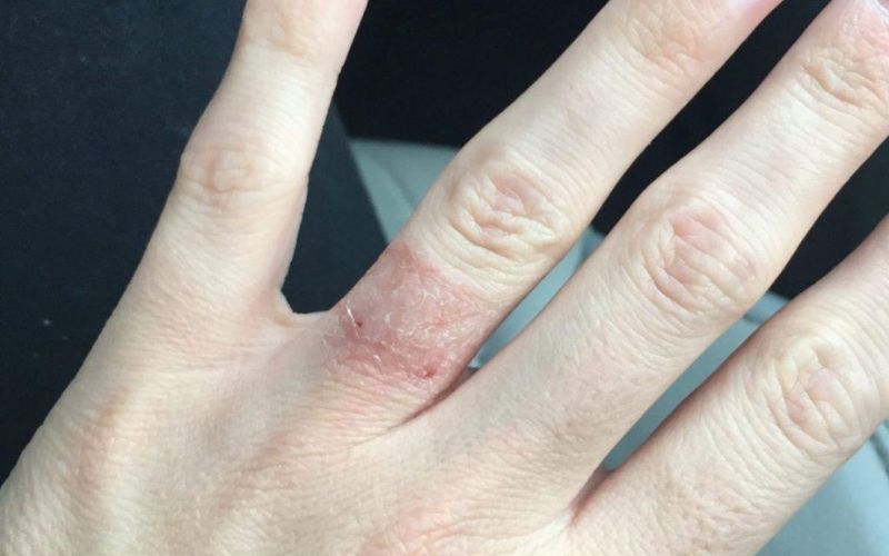 Nếu bạn có làn da nhạy cảm, hãy thử đeo nhẫn trong một thời gian ngắn (vài giờ) để xem có phản ứng gì không